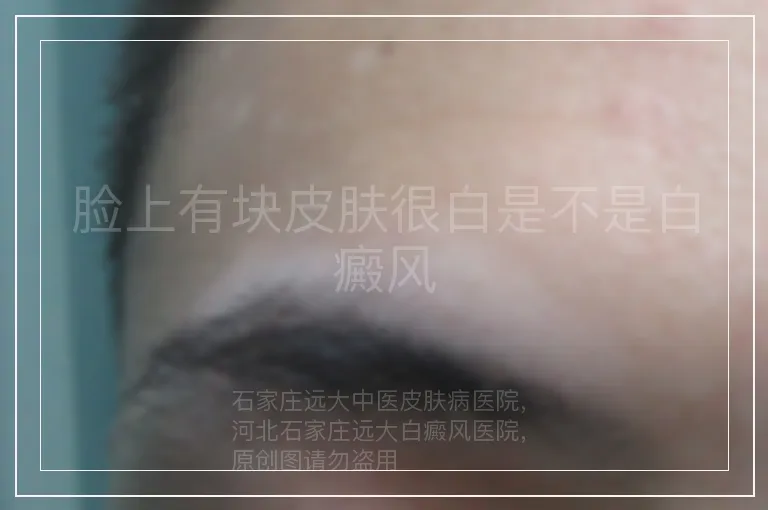 脸上有块皮肤很白是不是白癜风