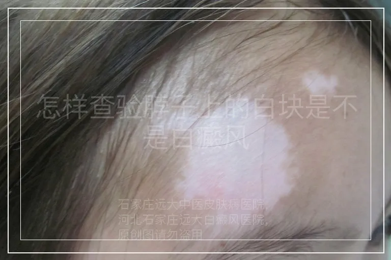 怎样查验脖子上的白块是不是白癜风