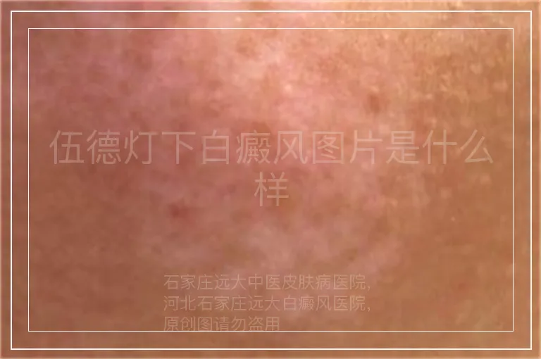 伍德灯下白癜风图片是什么样
