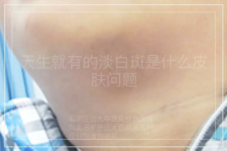 天生就有的淡白斑是什么皮肤问题