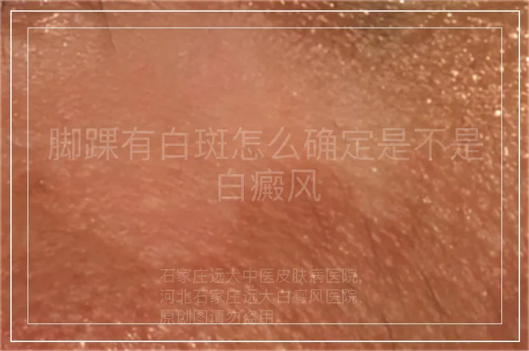 脚踝有白斑怎么确定是不是白癜风