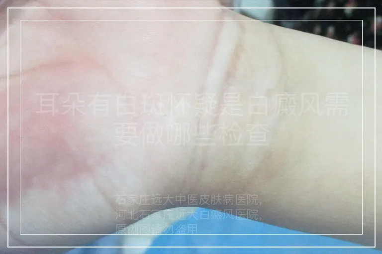 耳朵有白斑怀疑是白癜风需要做哪些检查