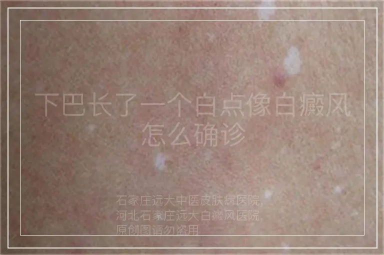 下巴长了一个白点像白癜风怎么确诊