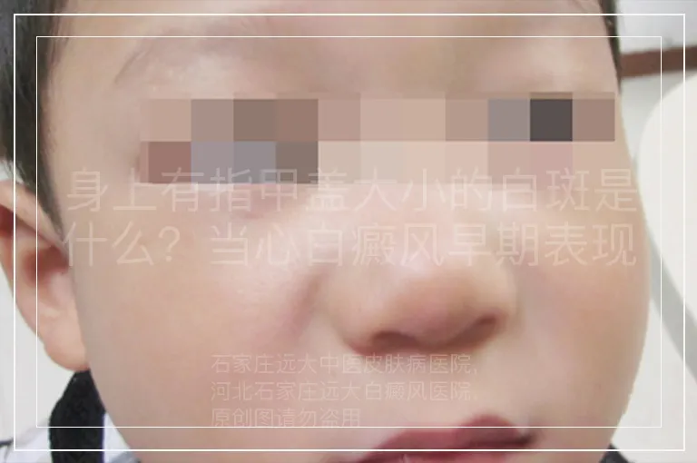 身上有指甲盖大小的白斑是什么？当心白癜风早期表现