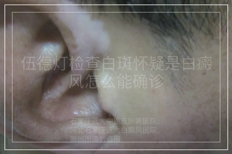 伍德灯检查白斑怀疑是白癜风怎么能确诊