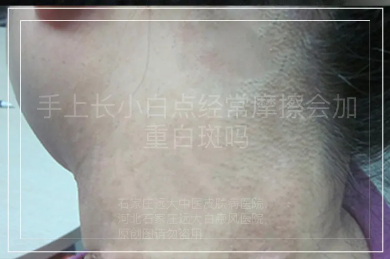 手上长小白点经常摩擦会加重白斑吗