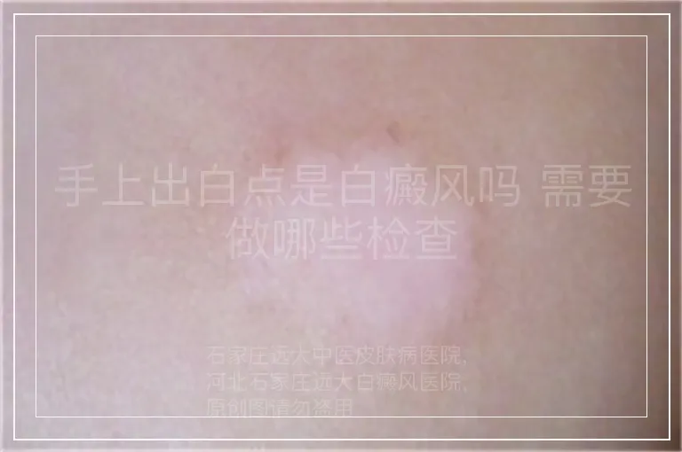 手上出白点是白癜风吗 需要做哪些检查