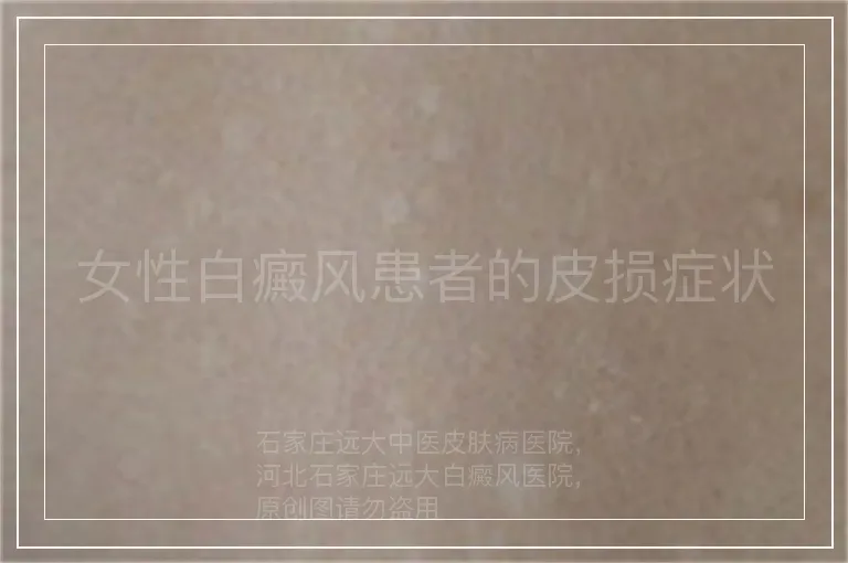 女性白癜风患者的皮损症状