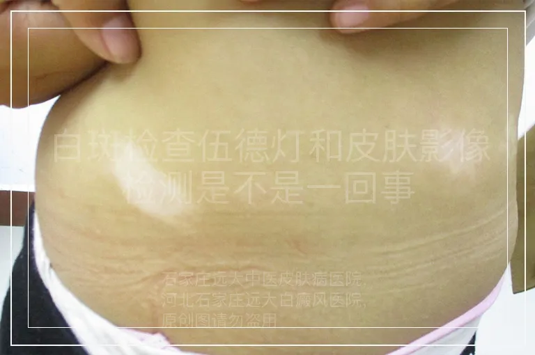 白斑检查伍德灯和皮肤影像检测是不是一回事