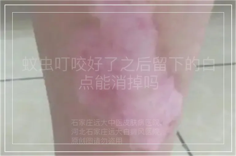 蚊虫叮咬好了之后留下的白点能消掉吗