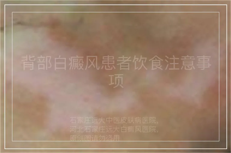 背部白癜风患者饮食注意事项
