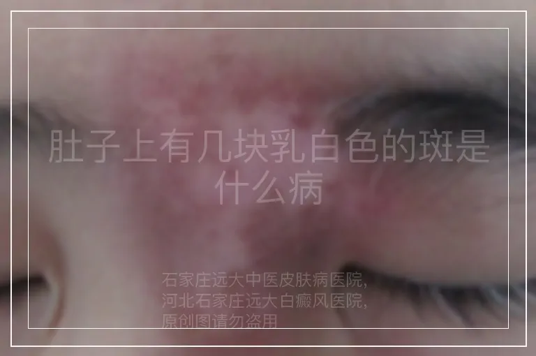 肚子上有几块乳白色的斑是什么病