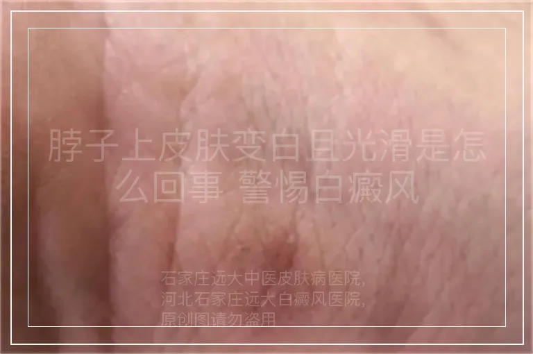脖子上皮肤变白且光滑是怎么回事 警惕白癜风