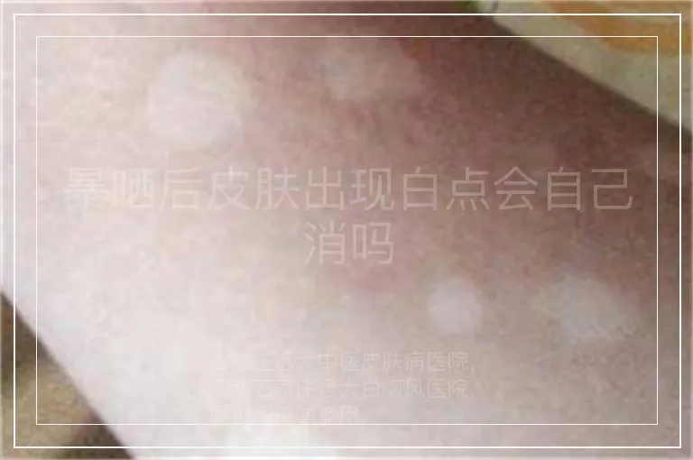 暴晒后皮肤出现白点会自己消吗