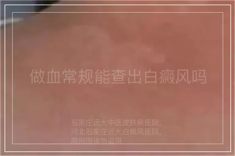 做血常规能查出白癜风吗