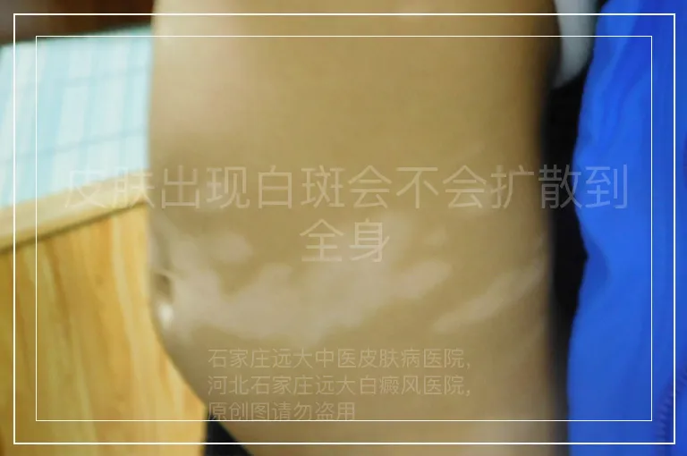 皮肤出现白斑会不会扩散到全身