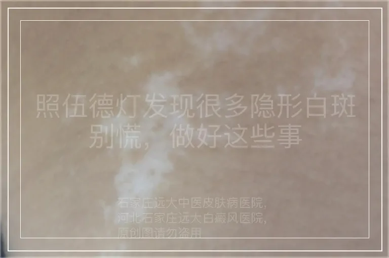照伍德灯发现很多隐形白斑别慌，做好这些事