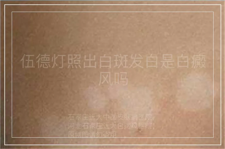 伍德灯照出白斑发白是白癜风吗