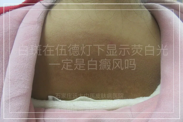 白斑在伍德灯下显示荧白光一定是白癜风吗
