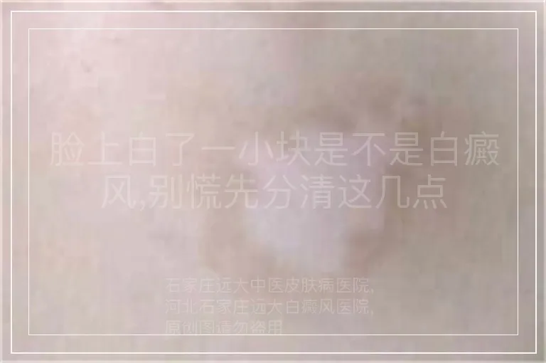 脸上白了一小块是不是白癜风,别慌先分清这几点