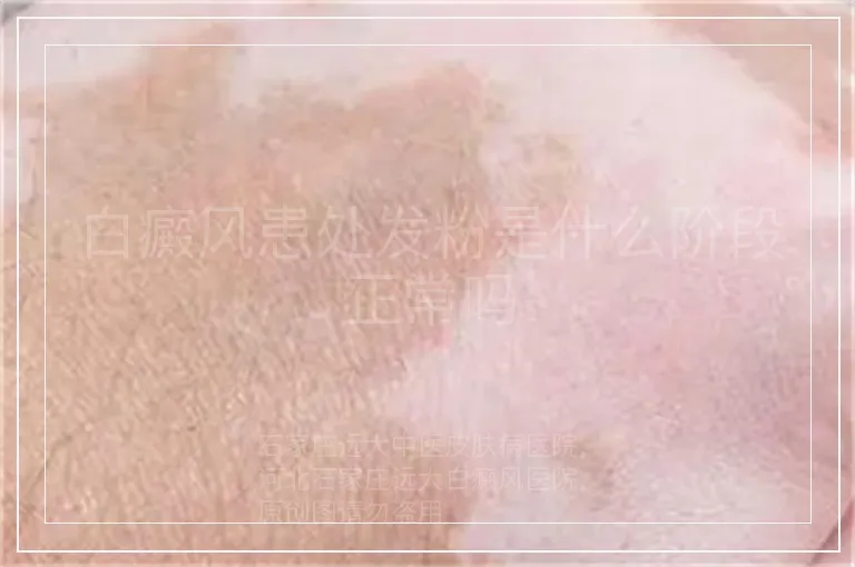 白癜风患处发粉是什么阶段正常吗