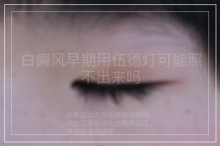 白癜风早期用伍德灯可能照不出来吗