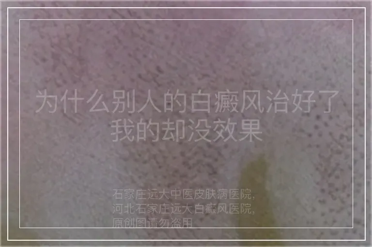 为什么别人的白癜风治好了我的却没效果