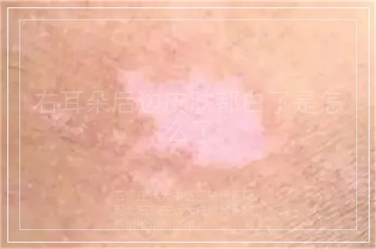 右耳朵后边皮肤都白了是怎么了
