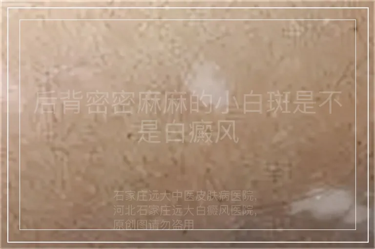 后背密密麻麻的小白斑是不是白癜风