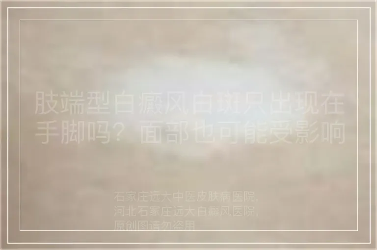 肢端型白癜风白斑只出现在手脚吗?面部也可能受影响