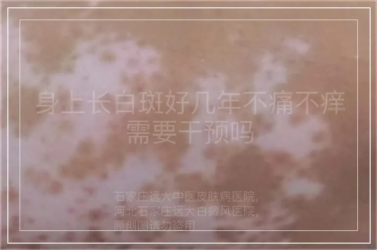 身上长白斑好几年不痛不痒需要干预吗