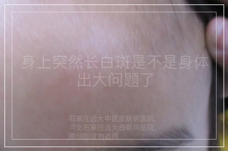 身上突然长白斑是不是身体出大问题了