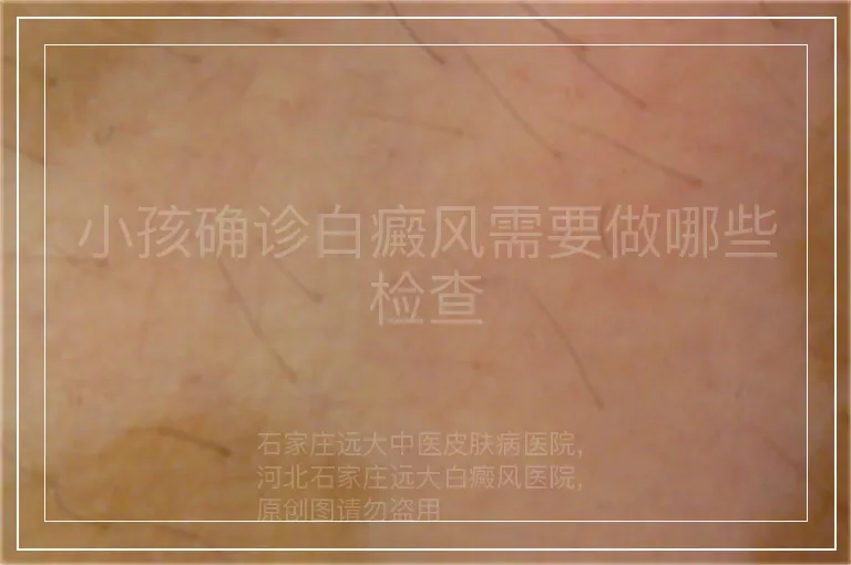小孩确诊白癜风需要做哪些检查