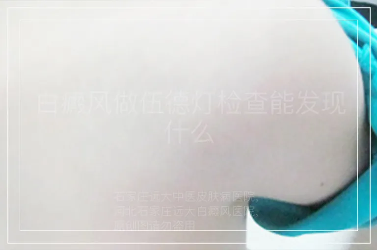 白癜风做伍德灯检查能发现什么