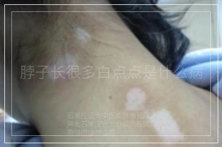 脖子长很多白点点是什么病