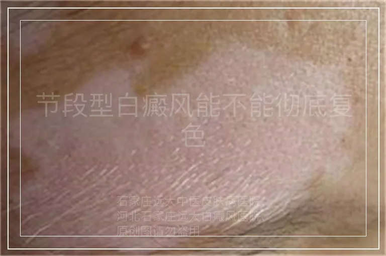 节段型白癜风能不能彻底复色