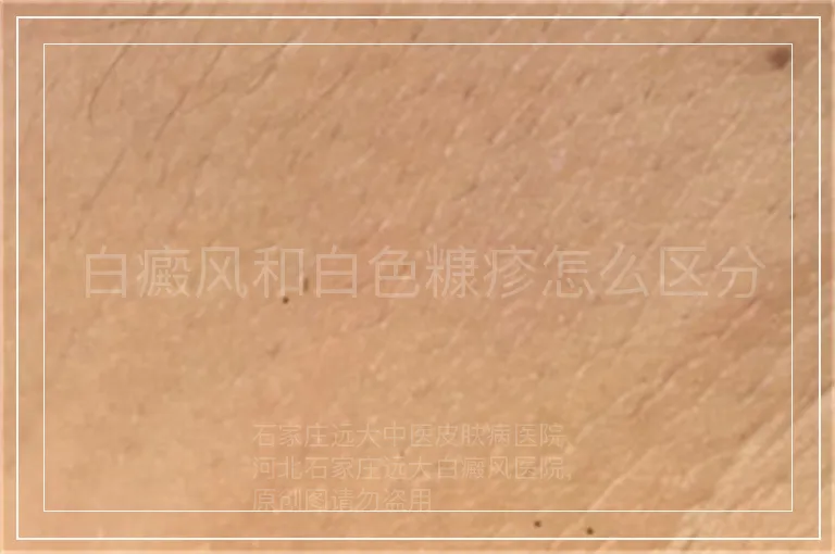 白癜风和白色糠疹怎么区分