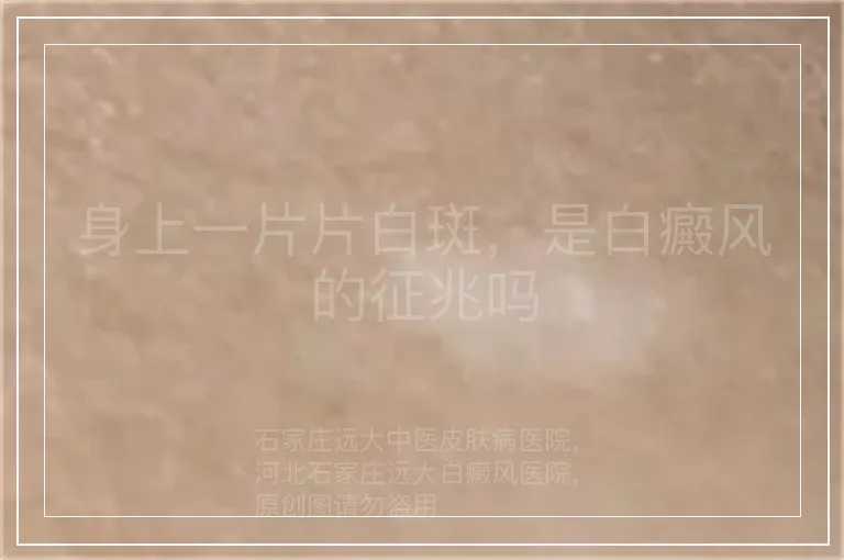 身上一片片白斑，是白癜风的征兆吗