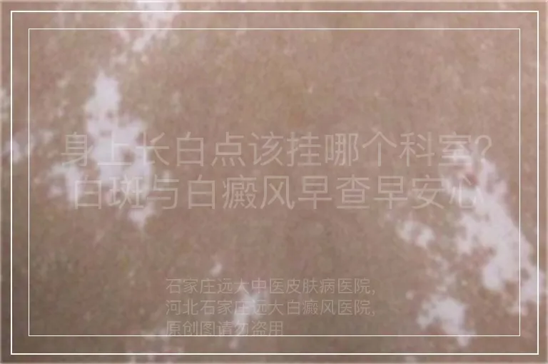身上长白点该挂哪个科室？白斑与白癜风早查早安心