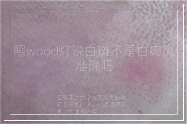 照wood灯说白斑不是白癜风准确吗