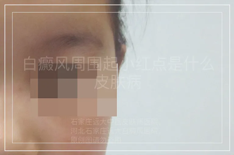 白癜风周围起小红点是什么皮肤病