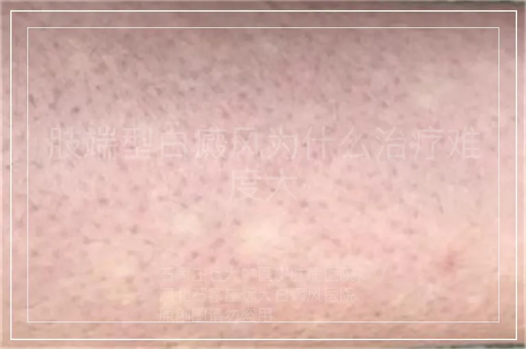 肢端型白癜风为什么治疗难度大