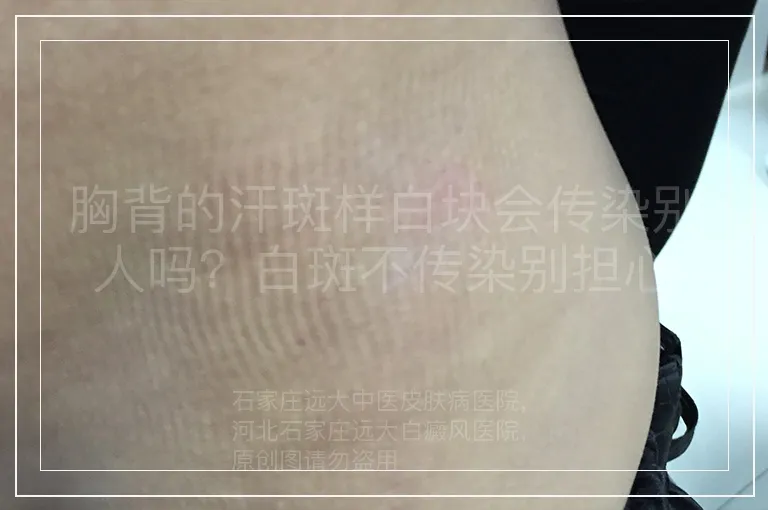 胸背的汗斑样白块会传染别人吗？白斑不传染别担心