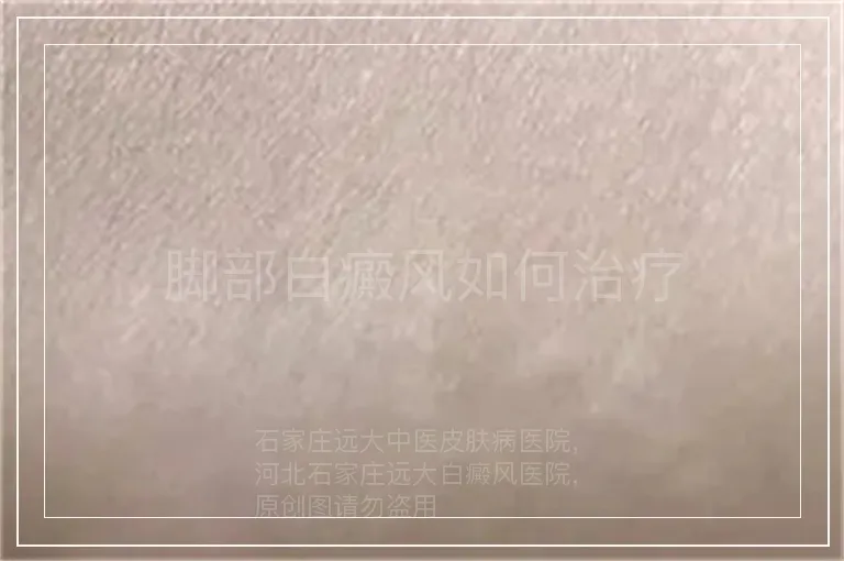 脚部白癜风如何治疗