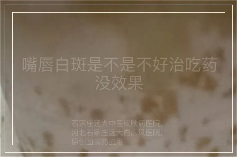 嘴唇白斑是不是不好治吃药没效果