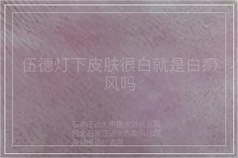 伍德灯下皮肤很白就是白癜风吗