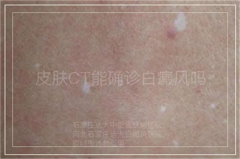 皮肤CT能确诊白癜风吗