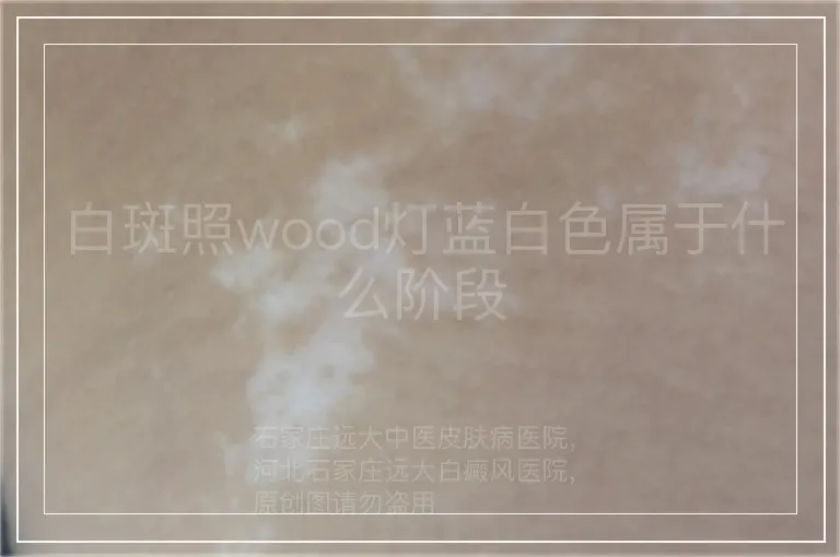 白斑照wood灯蓝白色属于什么阶段