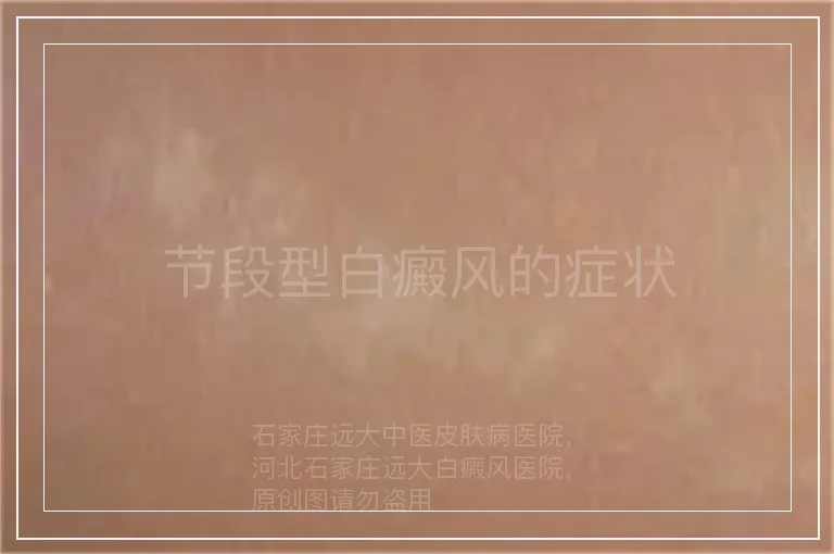 节段型白癜风的症状