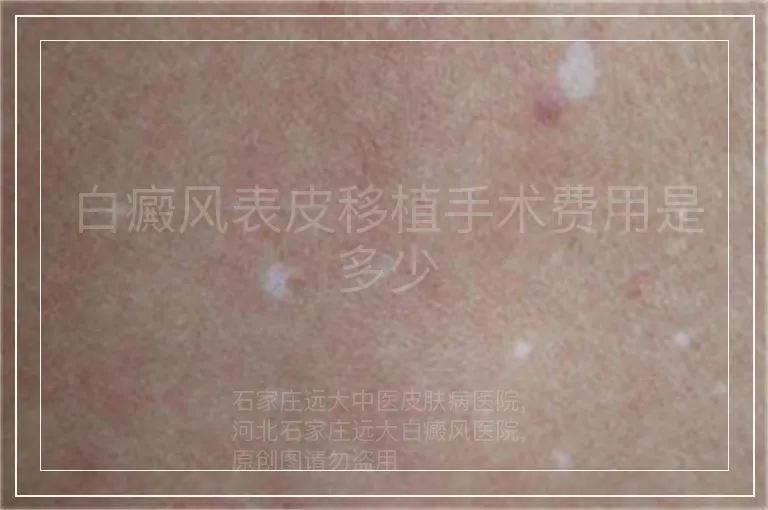 白癜风表皮移植手术费用是多少